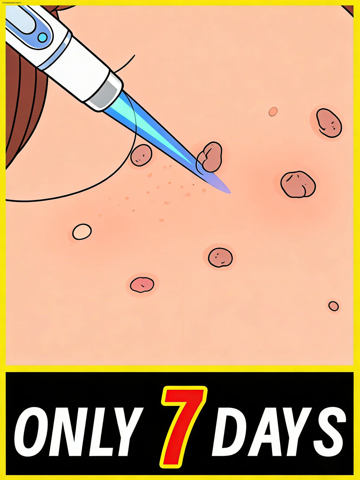 Painless ᴡᴀʀᴛ removal pen – Home skincare solution CB DROPSHIPPING