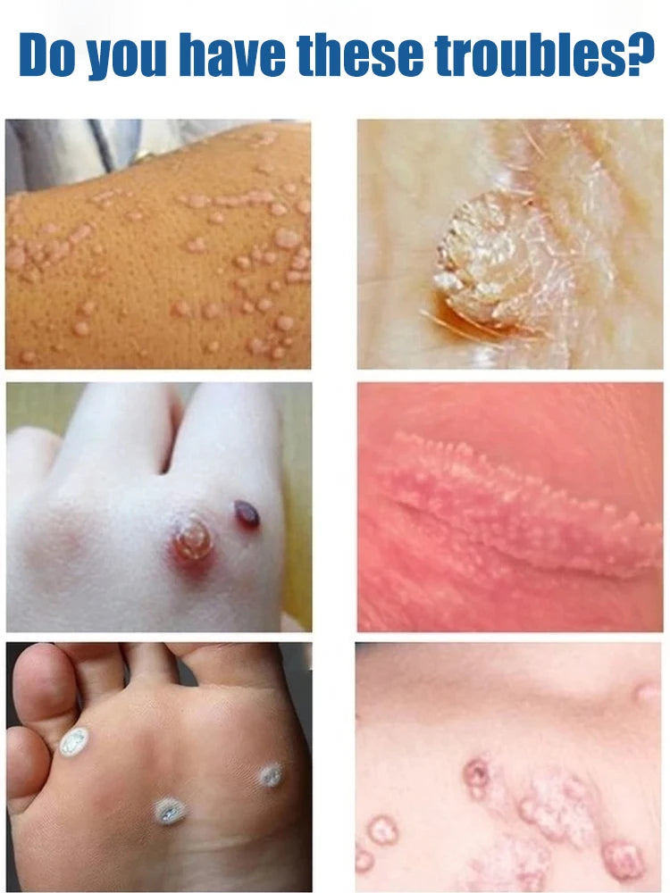 Painless ᴡᴀʀᴛ removal pen – Home skincare solution CB DROPSHIPPING